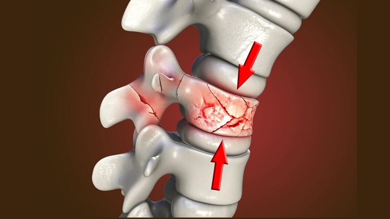 درمان انواع شکستگی‌های ستون فقرات | بهترین متخصص ارتوپدی اصفهان | دکتر هادی ملاعباسی