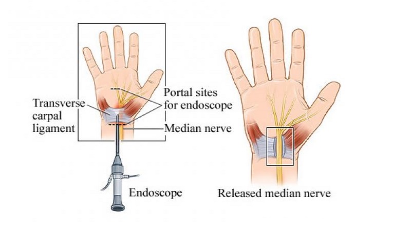 روش‌های جراحی عصب مچ دست | بهترین متخصص ارتوپدی اصفهان | دکتر هادی ملاعباسی